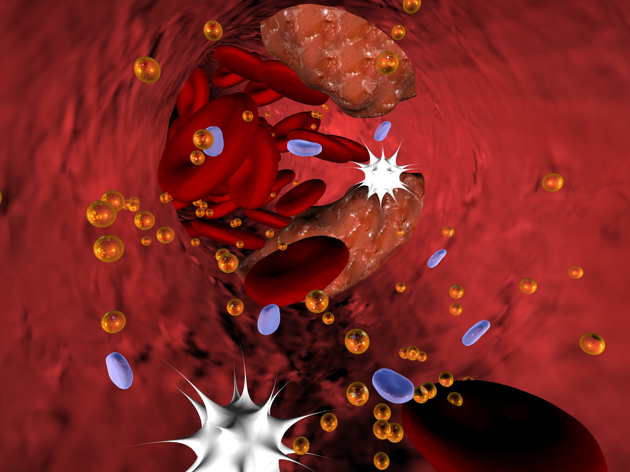 What leads to cholesterol clogging up your arteries?