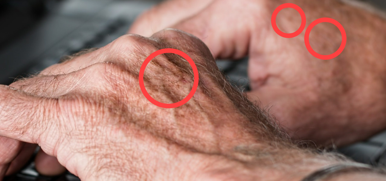 What exactly are age spots and what do they mean?