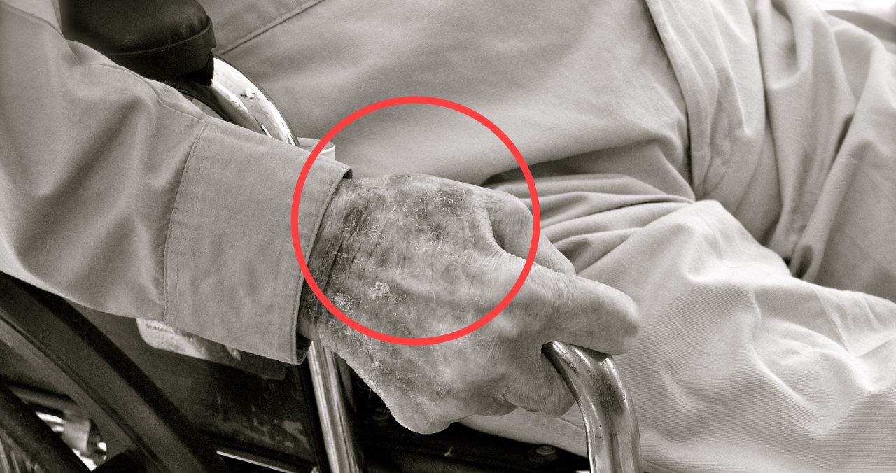 What you should do against age spots (cells rich in lipofuscin):