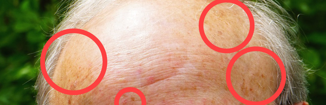 Age spots on forehead